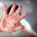 Nicaragua atenta a viruela símica ante declaración de emergencia sanitaria global