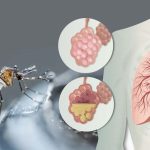 Dengue registra aumento del 21% en casos positivos, mientras que la Neumonía muestra una disminución del 7%.